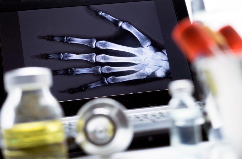 Hand xray radiography used to diagnose arthritis in Tampa FL