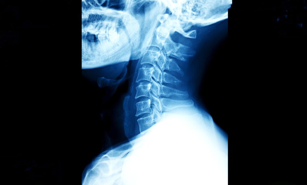 Neck and spine xray used to diagnose whiplash injuries at Mast Health